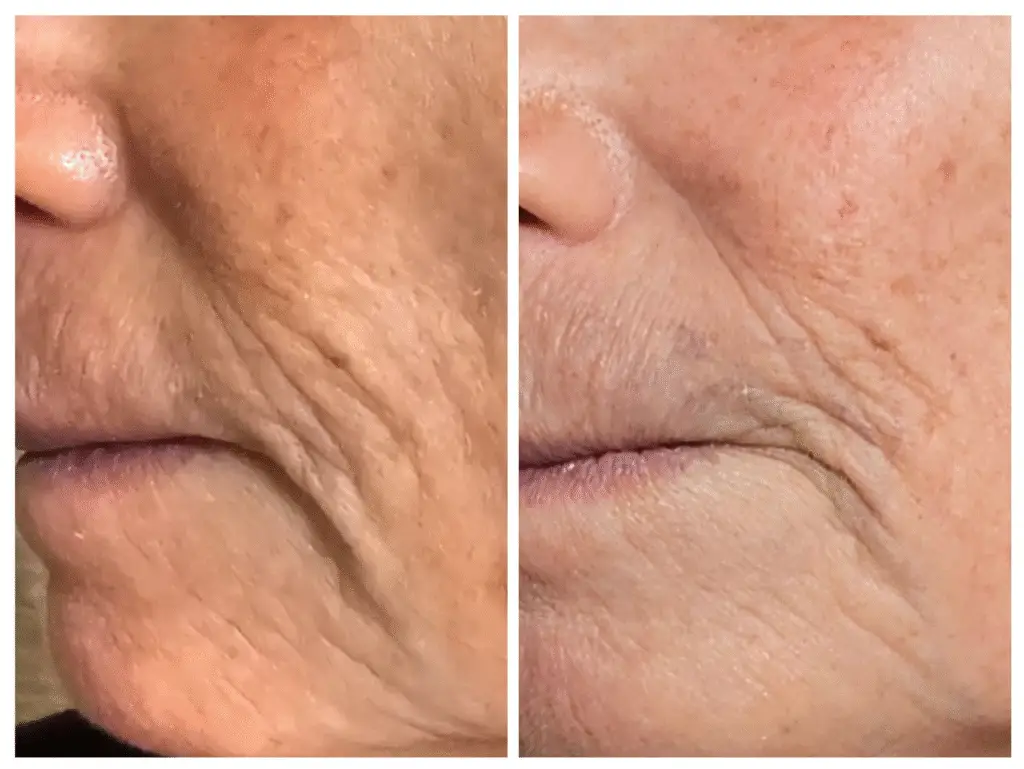 before and after microneedling