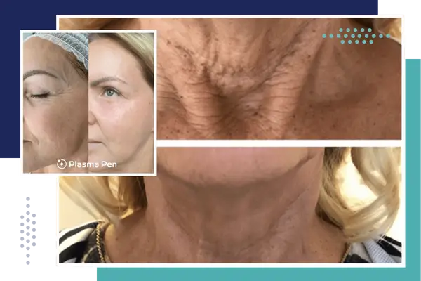 before and after results